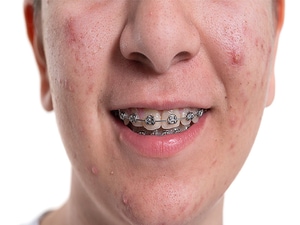 2024 AAD Acne Guidelines: Newer Therapies Join Old Standbys