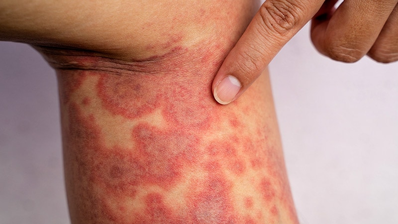 Can Smokers Safely Use Upadacitinib for Atopic Dermatitis?